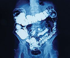 Inflamed intestinal track